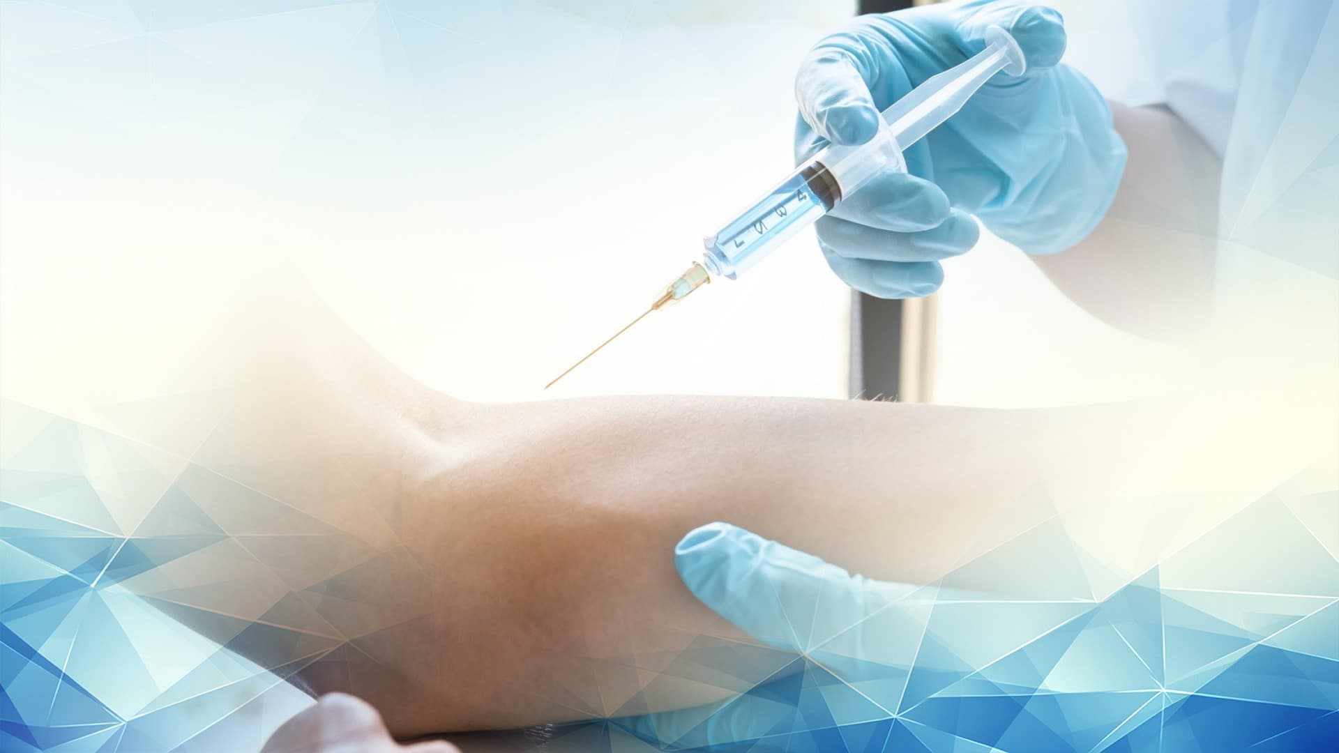 Who Should Consider Arthrosamid Injections for Knee Osteoarthritis