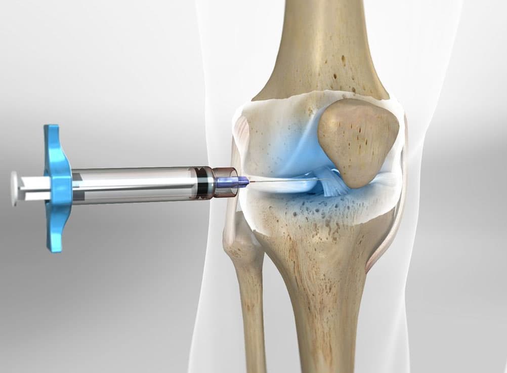 Osteoarthritis (specifically knees)