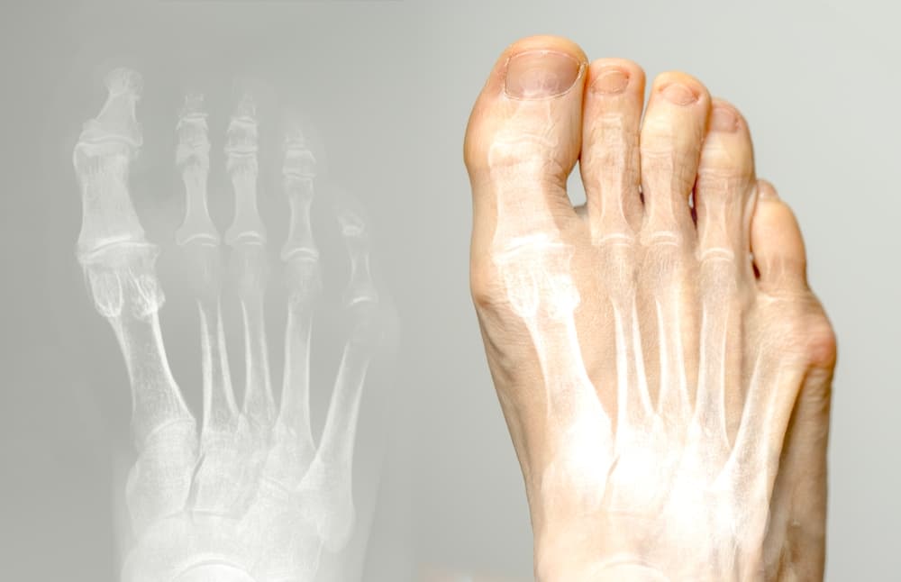 Hallux Rigidus (Stiff Big Toe)