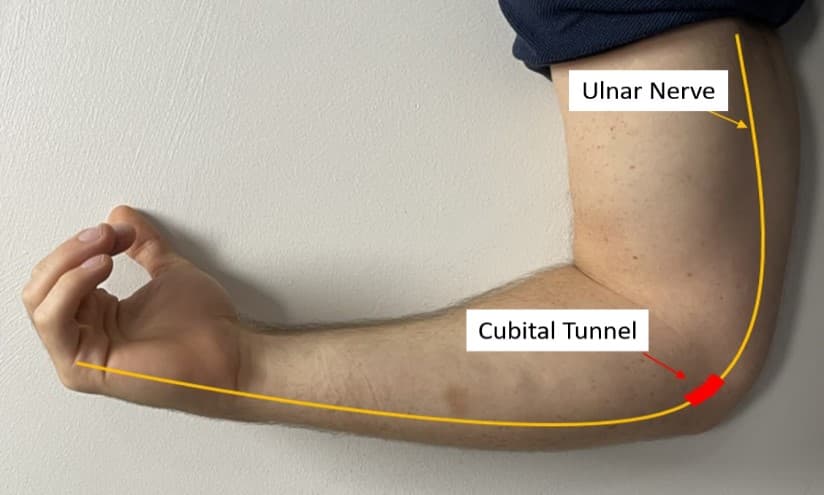 Cubital Tunnel Syndrome