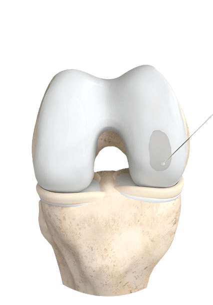 Liquid cartilage injections