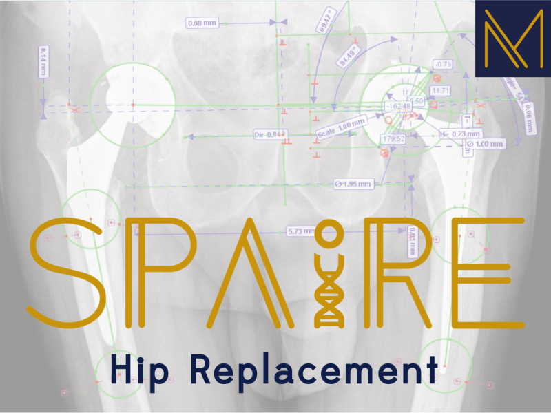 SPAIRE Hip - Preserving Muscles and Anatomy Enhancing Hip Stability and Recovery.
